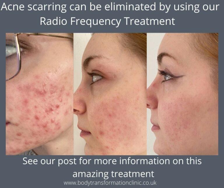 Acne scarring can be Emilimated 768x644