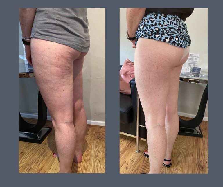 Cellulite Reduction  768x644