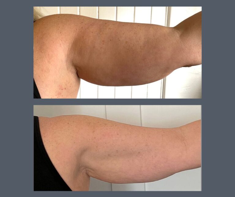 Fat Freeze Arms before and after 768x644