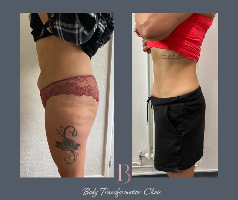 Fat Freeze Before And After 1 copy 768x644