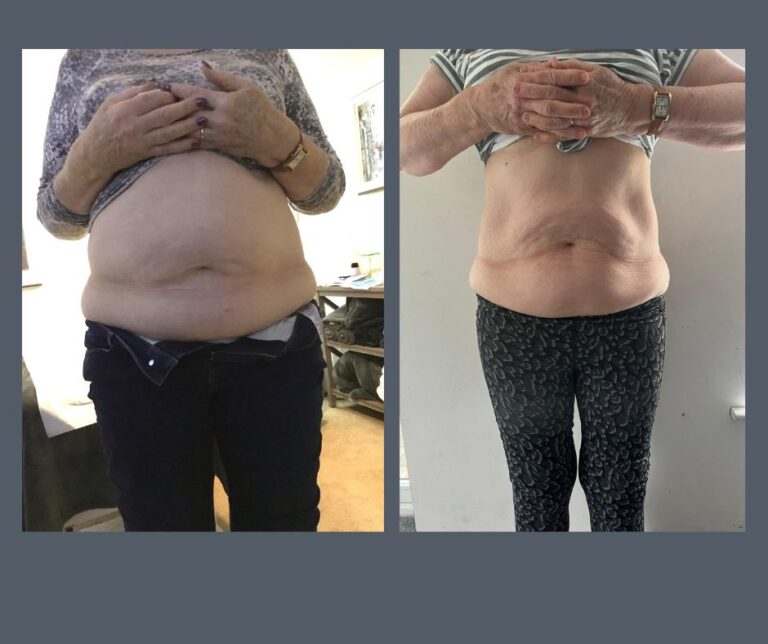 Fat Freeze before and after 2 768x644