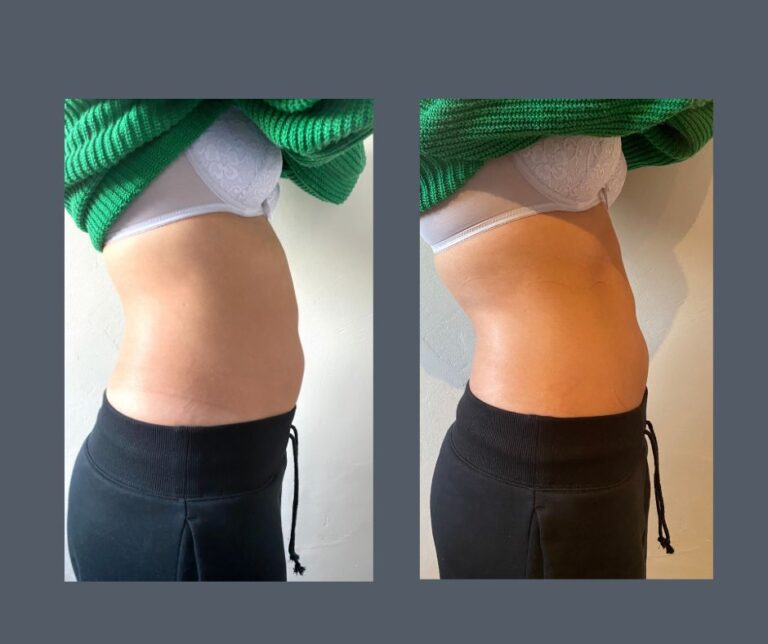 Laser Lipo Instant Fat Reduction copy 768x644