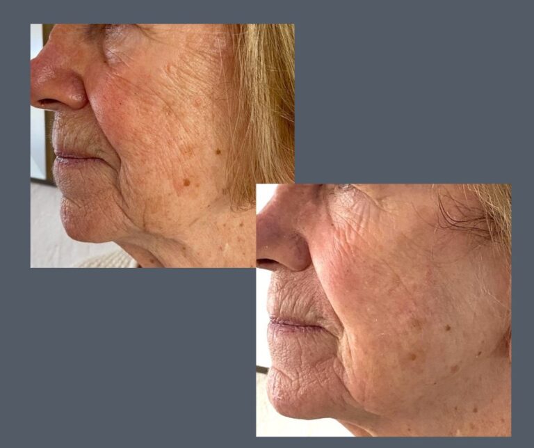 Radio Frequency Non Surgical face Lift 768x644